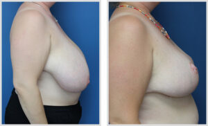 Breast Reduction & Free Nipple Graft (Side)
