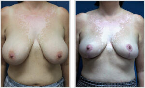 Breast Reduction (Front)