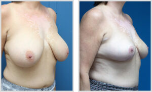 Breast Reduction (Oblique)