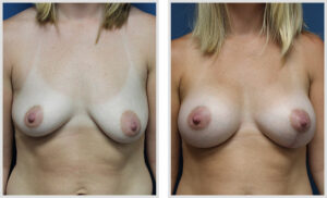 Breast Augmentation &Right Side Vertical Lift (Front)