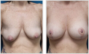 Breast Augmentation &Right Side Vertical Lift (Front)