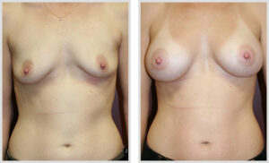 Breast Augmentation (Front)