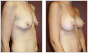 Breast Augmentation (Oblique)