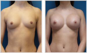 Breast Augmentation (Front)