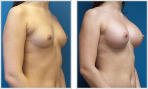 Breast Augmentation (Oblique)