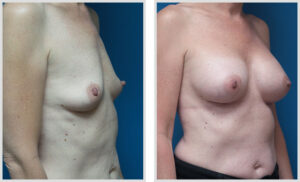Breast Augmentation (Oblique)