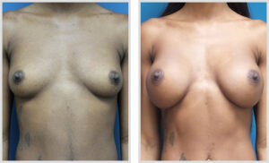 Breast Augmentation (Front)