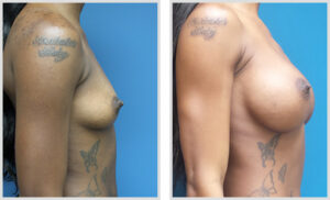 Breast Augmentation (Side)