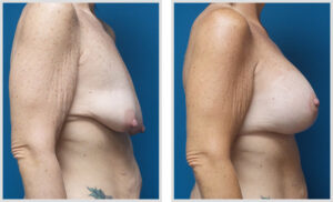 Breast Augmentation & Vertical&nbsp;Lift (Side)