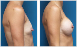 Breast Augmentation (Side)