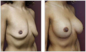 Breast Augmentation (Oblique)