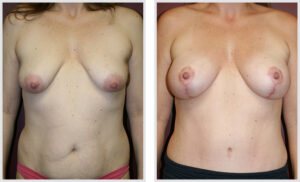Breast Lift (Front)