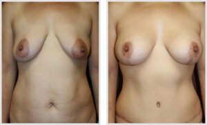 Breast Lift (Front)