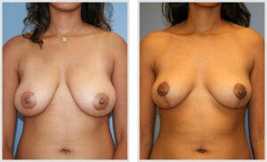 Breast Lift (Front)