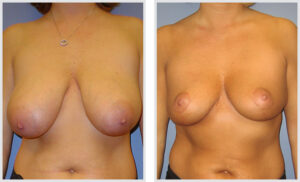 Breast Reduction (Front)