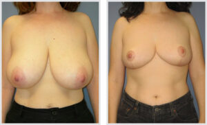 Breast Reduction (Front)