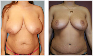 Breast Reduction (Front)