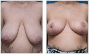 Breast Lift (Front)