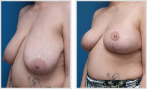 Breast Lift (Oblique)