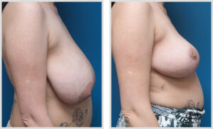 Breast Lift (Side)