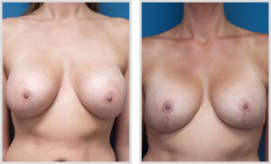 Breast Lift (Front)