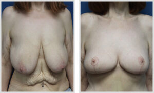 Breast Lift (Front)