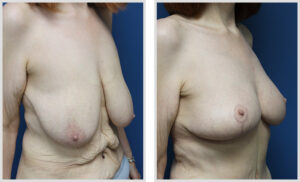 Breast Lift (Oblique)