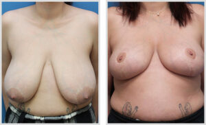 Breast Reduction (Front)