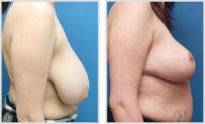 Breast Reduction (Side)