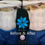Coolsculpting for men before and after