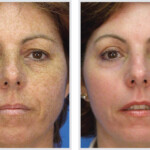 Face Microlaser Peel