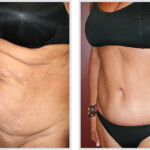 Tummy Tuck