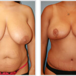Tummy Tuck