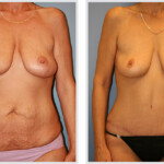Tummy Tuck