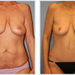 Tummy Tuck