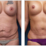 Tummy Tuck