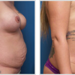 Tummy Tuck
