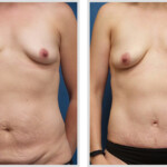 Tummy Tuck
