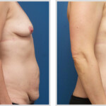 Tummy Tuck