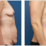 Tummy Tuck