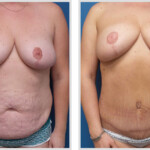 Tummy Tuck