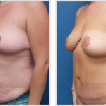 Tummy Tuck