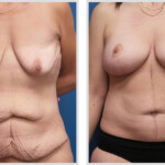 Tummy Tuck