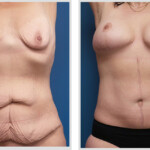 Tummy Tuck