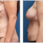 Tummy Tuck